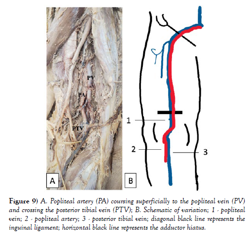 international-journal-anatomical-variations-Popliteal