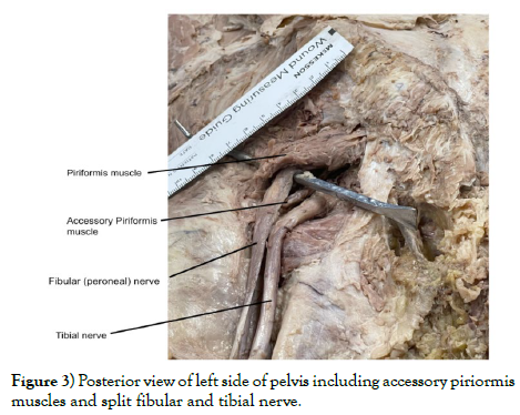 international-journal-anatomical-variations-left