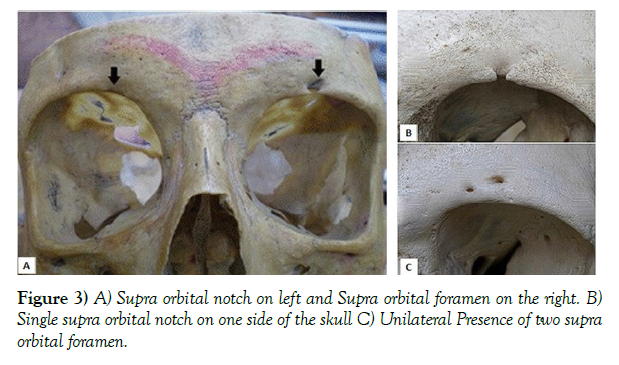 international-journal-anatomical-variations-orbital