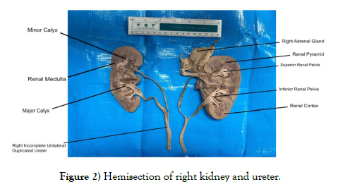 international-journal-anatomical-variations-right