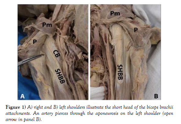 international-journal-anatomical-variations-right