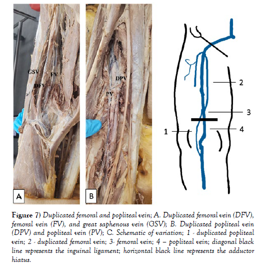 international-journal-anatomical-variations-saphenous