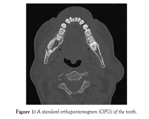 international-journal-anatomical-variations-tooth