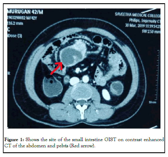 pulcncr-abdomen