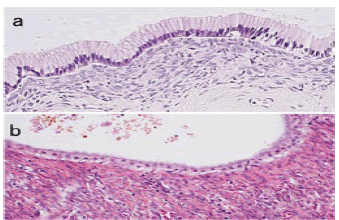 puljcdt-neoplasm