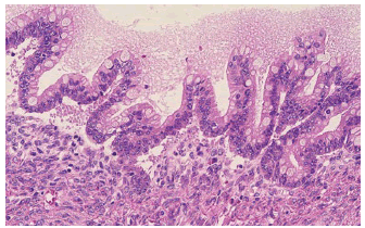 puljcdt-neuroendocrine