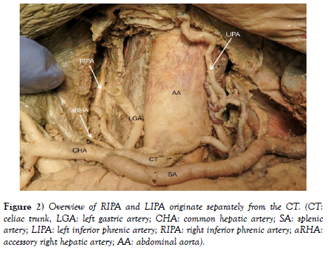 international-journal-anatomical-variations-RIPA