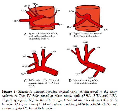 international-journal-anatomical-variations-Schematic