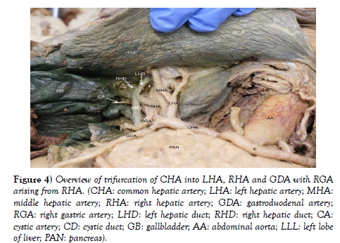 international-journal-anatomical-variations-trifurcation