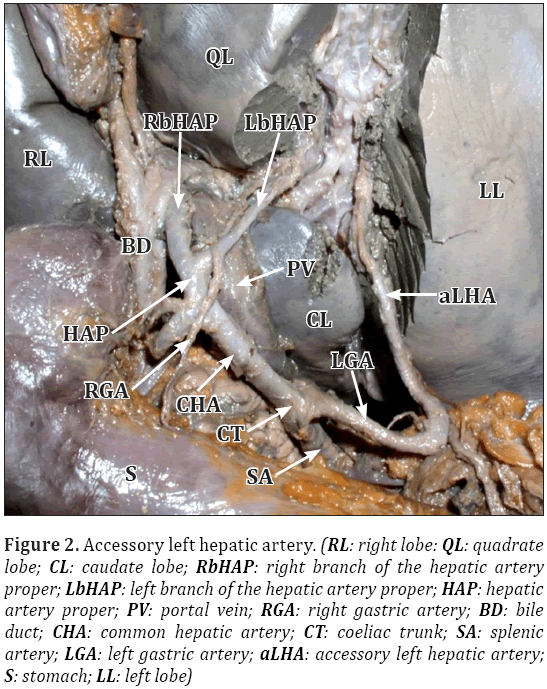 Anatomical-Variations-Accessory-left-hepatic