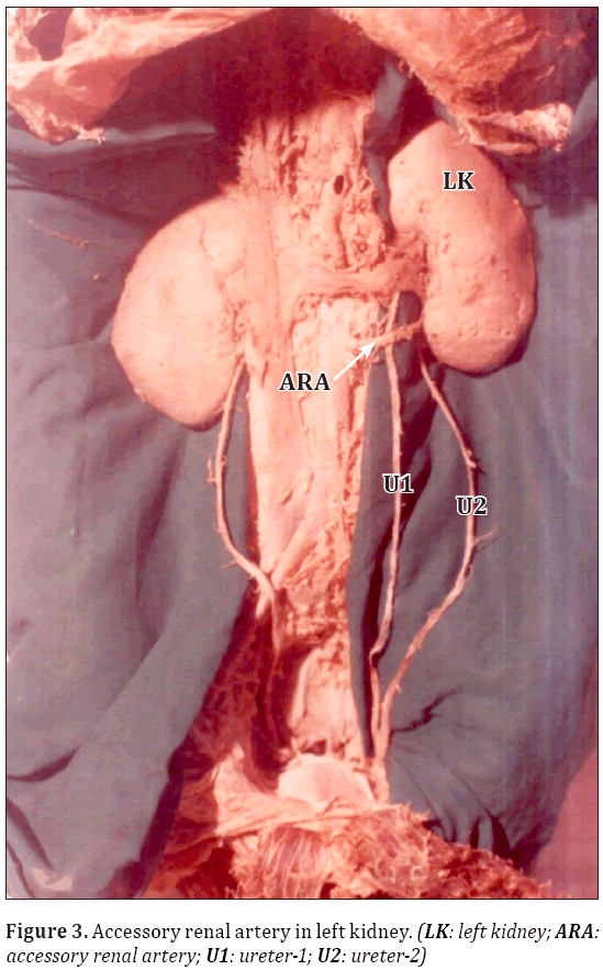 A case report on double ureter and accessory renal artery