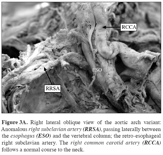 Anatomical-Variations-Anomalous-right-subclavian