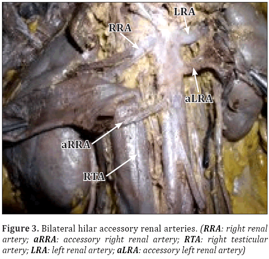 Anatomical-Variations-Bilateral-hilar-accessory