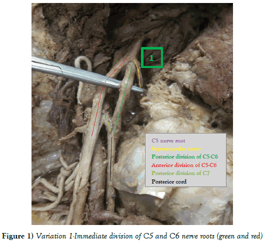 Anatomical-Variations-C6-nerve-roots