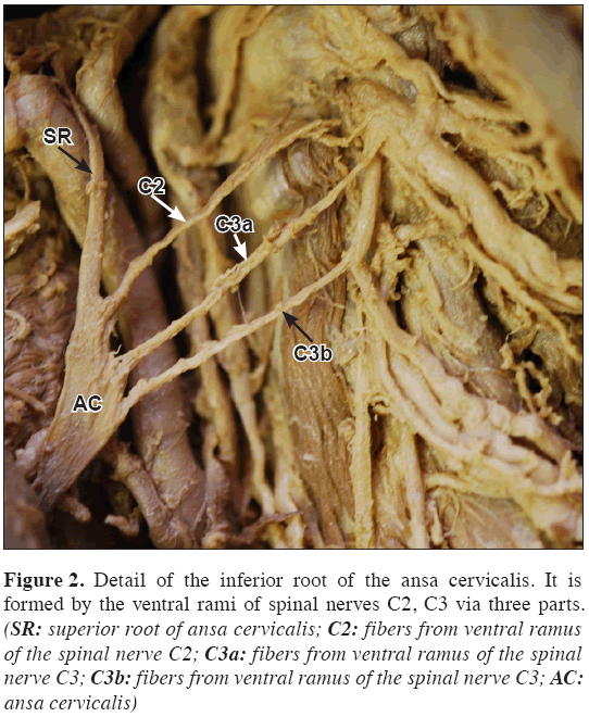 A variant case of ansa cervicalis