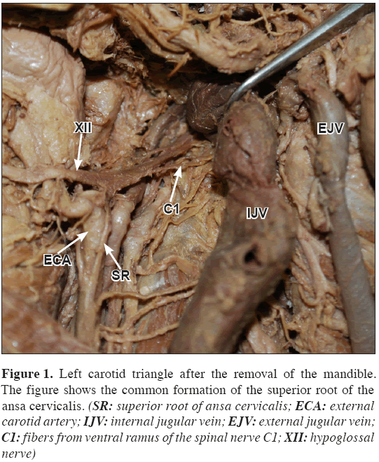 Anatomical-Variations-Left-carotid-triangle