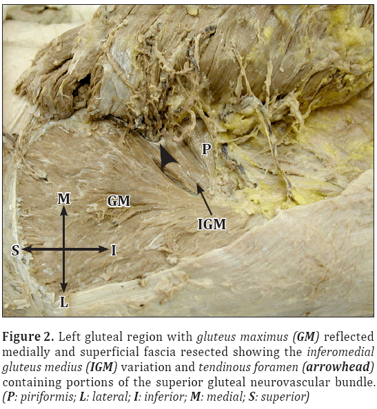 Anatomical-Variations-Left-gluteal-region