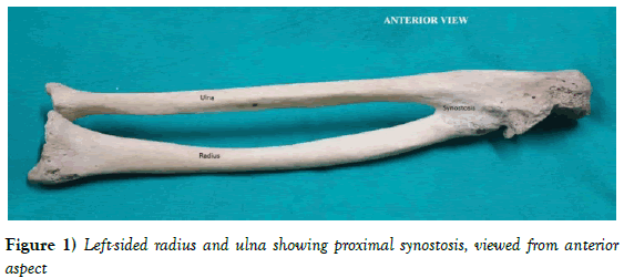 Anatomical-Variations-Left-sided-radius-ulna