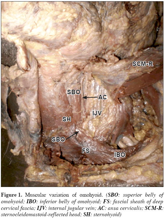 Anatomical-Variations-Muscular-variation-omohyoid