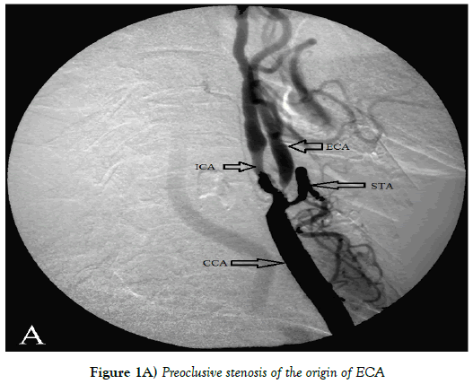 Anatomical-Variations-Preoclusive-stenosis