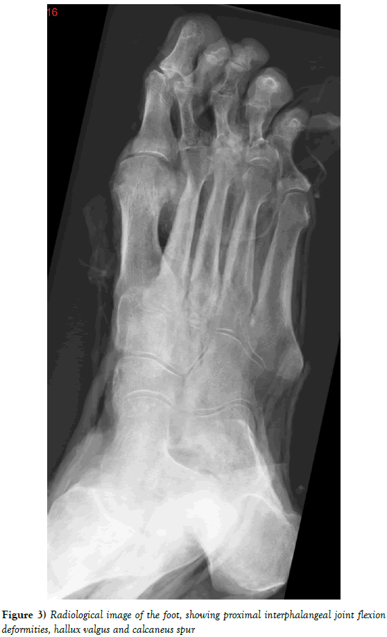 Anatomical-Variations-Radiological-image-foot