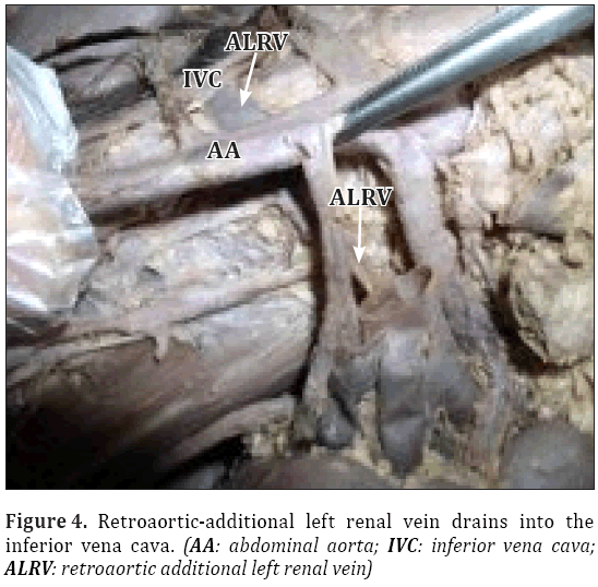 Anatomical-Variations-Retroaortic-additional-left