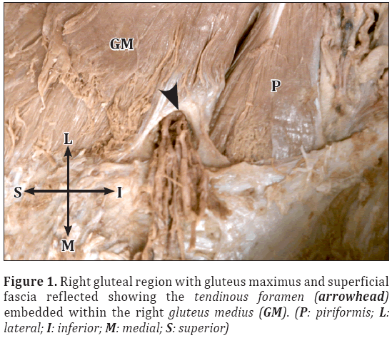 Anatomical-Variations-Right-gluteal-region