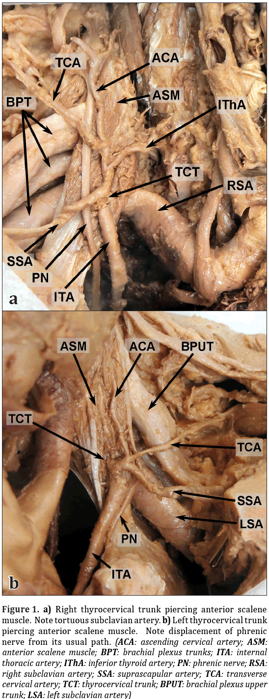 Anatomical-Variations-Right-thyrocervical-trunk