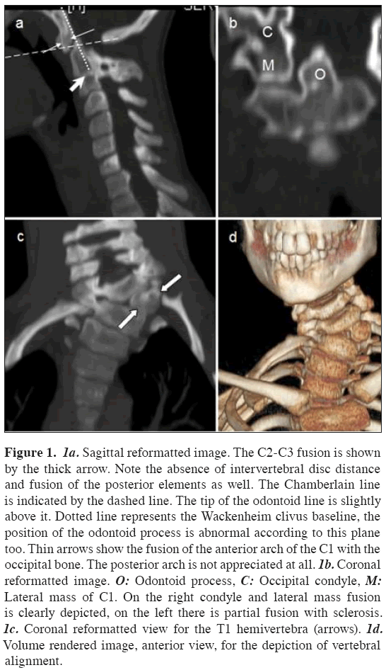 Anatomical-Variations-Sagittal-reformatted-image