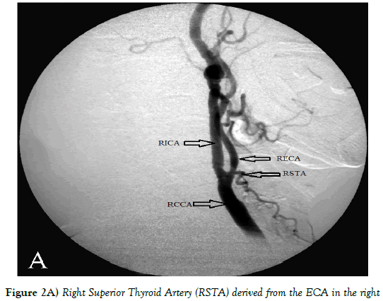 Anatomical-Variations-Superior-Thyroid-Artery