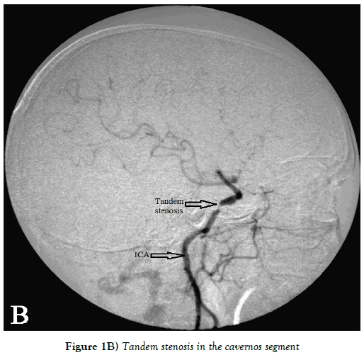 Anatomical-Variations-Tandem-stenosis