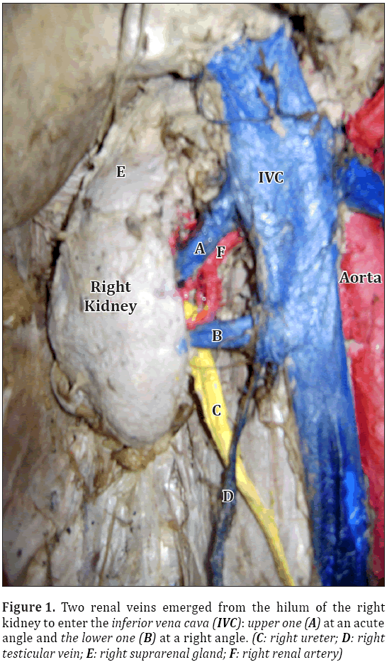 Anatomical-Variations-Two-renal-veins