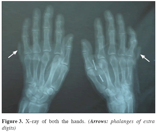 Anatomical-Variations-X-ray-both-hands