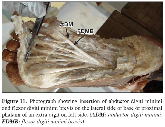 Anatomical-Variations-abductor-digiti-minimi