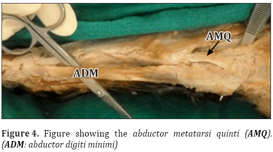 Anatomical-Variations-abductor-metatarsi-quinti