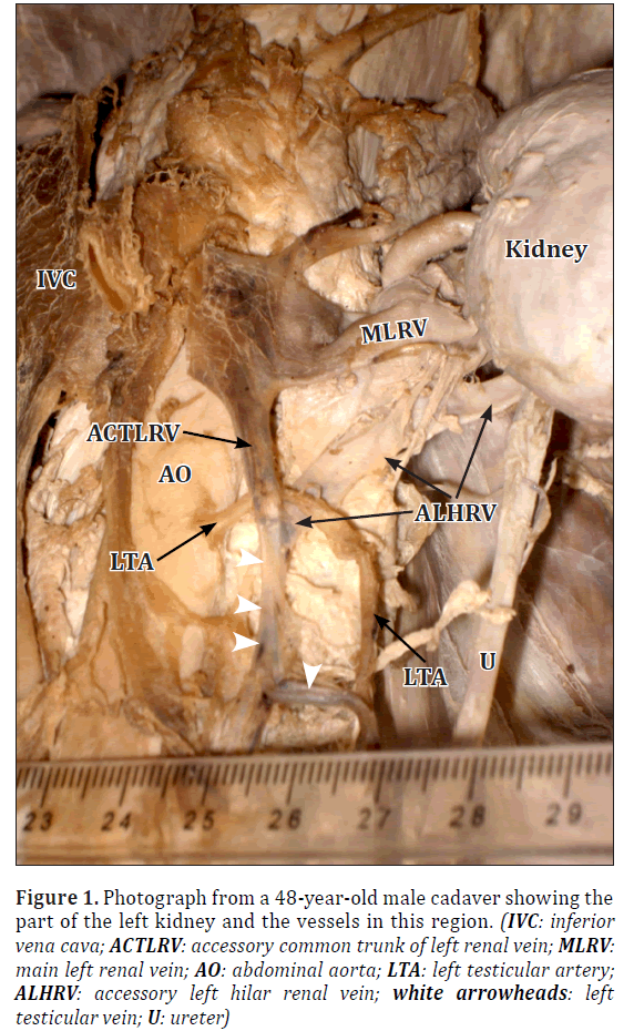 Anatomical-Variations-accessory-common