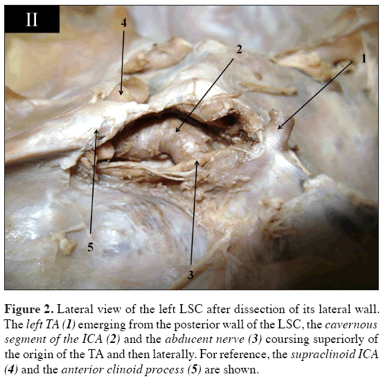 Anatomical-Variations-anterior-clinoid-process