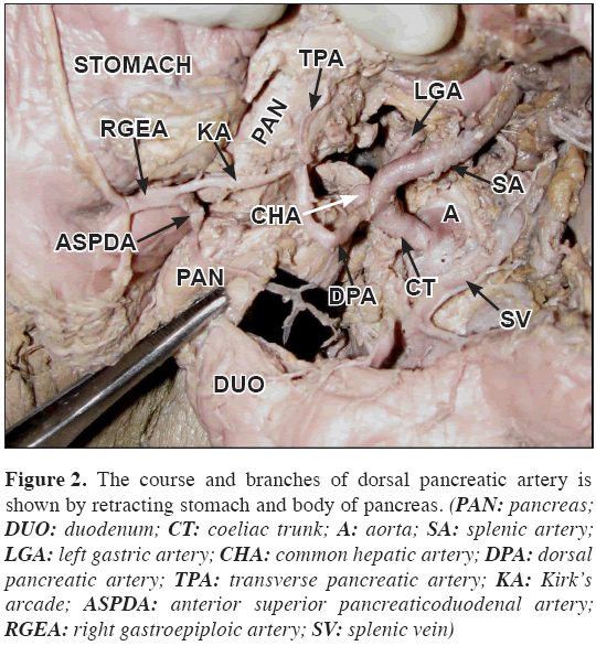 Anatomical-Variations-anterior-superior-pancreaticoduodenal