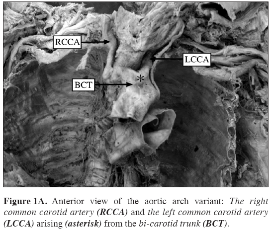 Anatomical-Variations-aortic-arch-variant