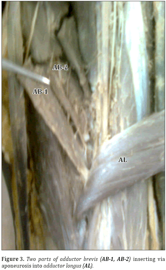 Anatomical-Variations-aponeurosis-adductor-longus