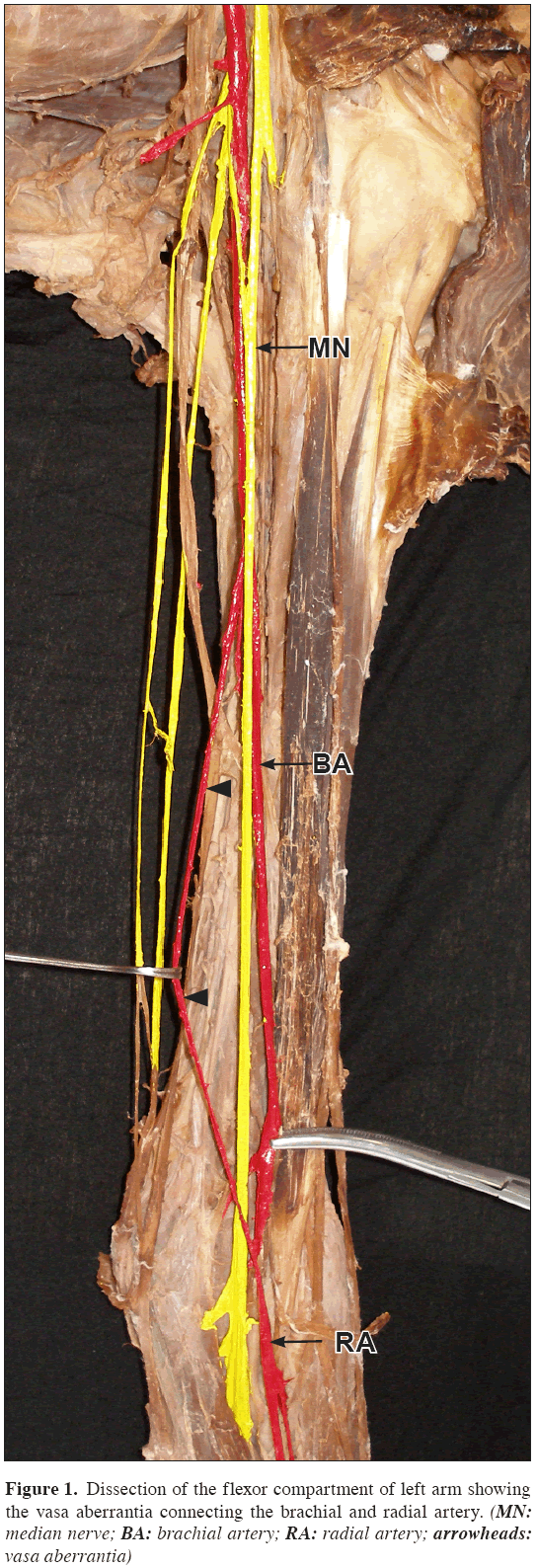 Anatomical-Variations-brachial-radial-artery