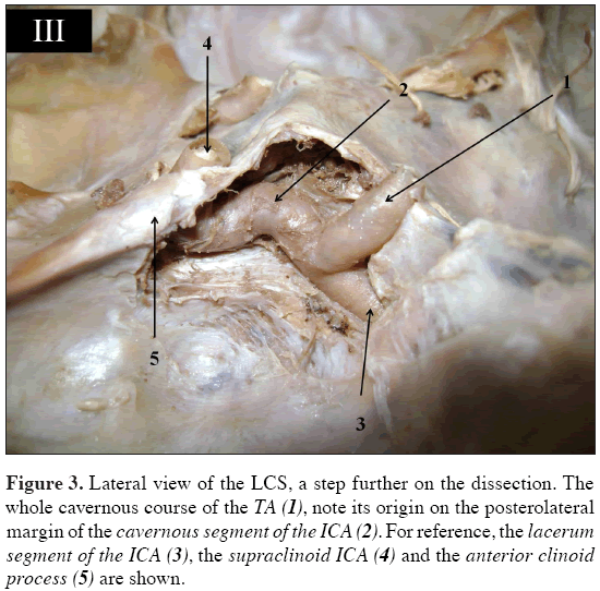 Anatomical-Variations-cavernous-segment-ICA