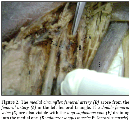 Anatomical-Variations-circumflex-femoral-artery