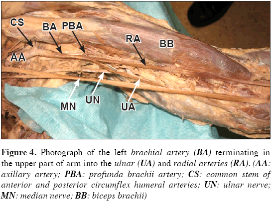 Anatomical-Variations-circumflex-humeral-arteries