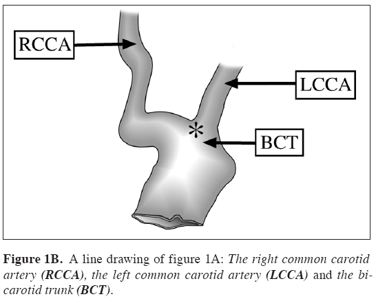 Anatomical-Variations-common-carotid-artery