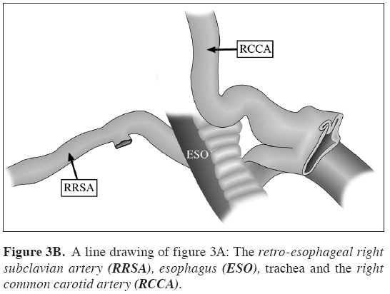 Anatomical-Variations-common-carotid-artery