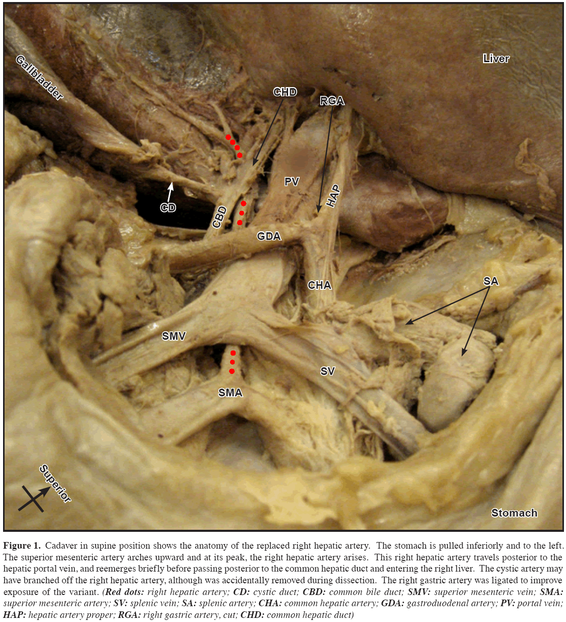 Anatomical-Variations-common-hepatic-duct