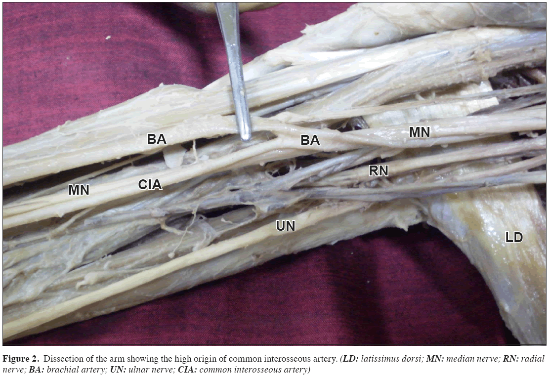 Anatomical-Variations-common-interosseous-artery