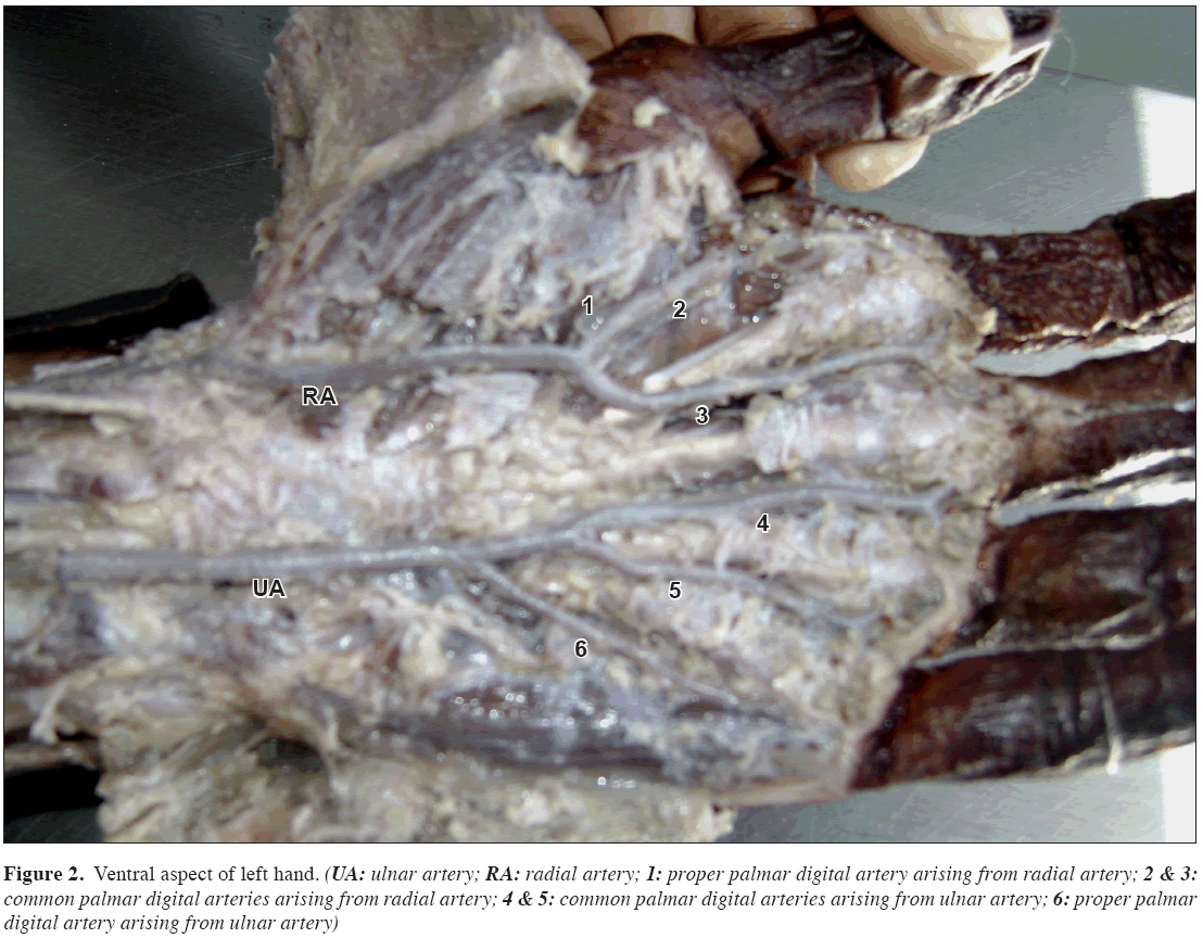 Anatomical-Variations-common-palmar-digital
