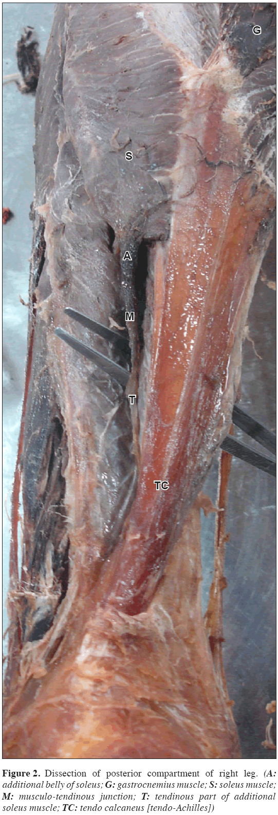 Anatomical-Variations-compartment-right-leg